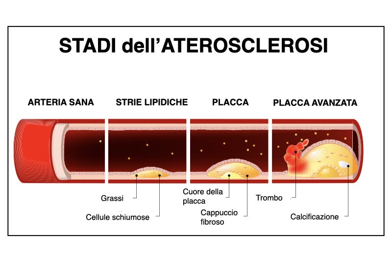 Infografica che illustra le fasi dell'aterosclerosi